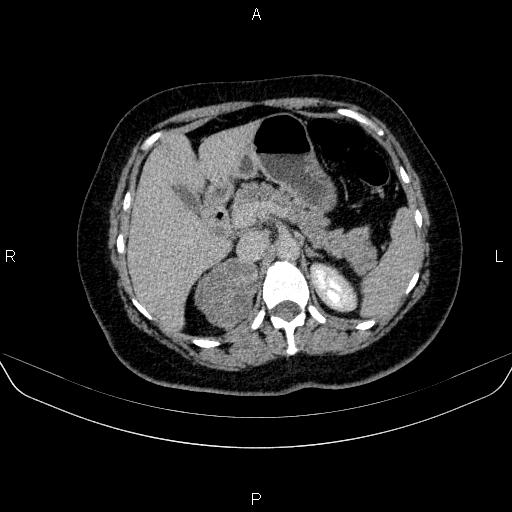 Adrenal cortical carcinoma (Radiopaedia 84882-100379 Axial C+ delayed 25).jpg