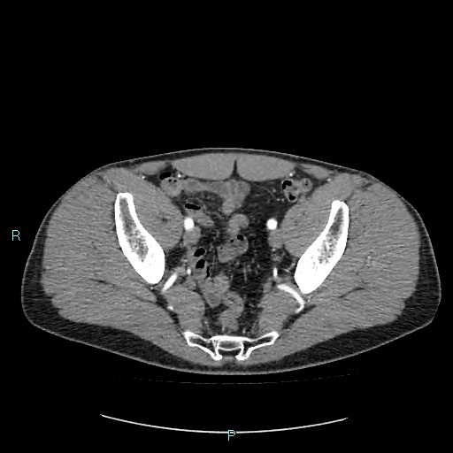 File:Adrenal cystic lymphangioma (Radiopaedia 83161-97534 Axial C+ arterial phase 83).jpg