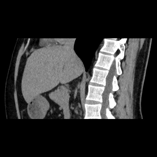 File:Adrenal gland trauma (Radiopaedia 81351-95079 Sagittal non-contrast 48).jpg