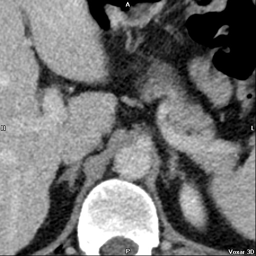 File:Adrenal glands (normal CT anatomy) (Radiopaedia 16570-105725 Axial 1).jpg