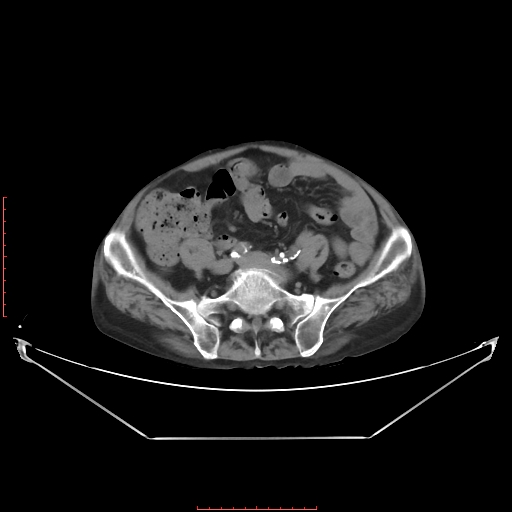 File:Adrenal hemangioma (Radiopaedia 68923-78668 Axial non-contrast 51).jpg