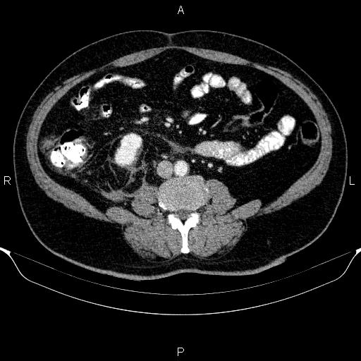 Adrenal hemorrhage (Radiopaedia 62622-70916 Axial C+ portal venous phase 110).jpg