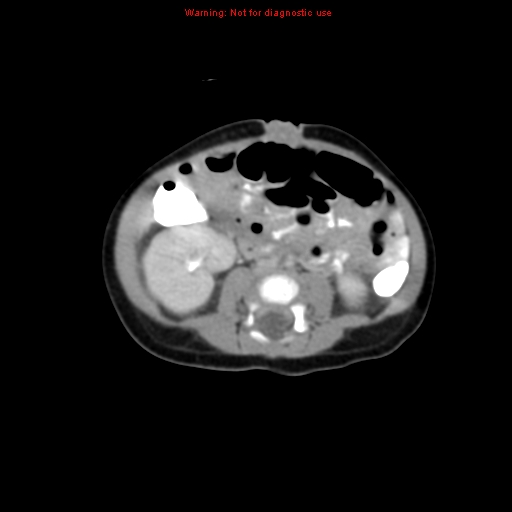 File:Adrenal hemorrhage (Radiopaedia 9390-10077 Axial C+ portal venous phase 21).jpg