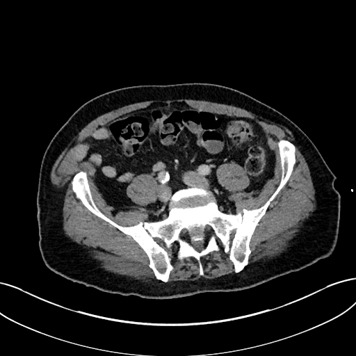 File:Adrenal lymphoma (Radiopaedia 73730-84529 Axial C+ portal venous phase 90).jpg