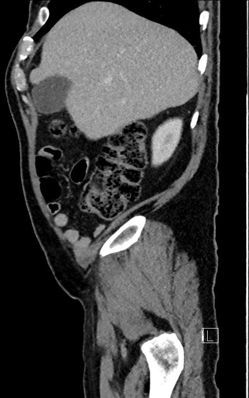 Adrenal lymphoma (Radiopaedia 73730-84529 Sagittal C+ portal venous phase 19).jpg
