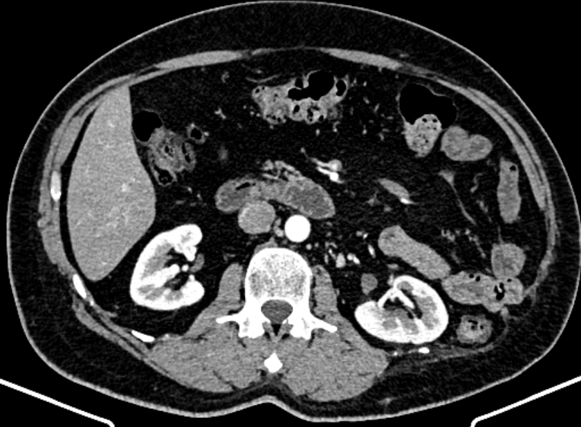 Adrenal metastases (Radiopaedia 73082-83791 Axial C+ arterial phase 78).jpg