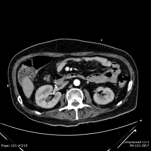 File:Adrenal metastasis (Radiopaedia 78425-91079 Axial C+ arterial phase 51).jpg