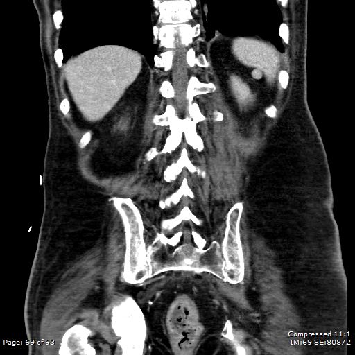 Adrenal metastasis (Radiopaedia 78425-91079 Sagittal C+ portal venous phase 56).jpg