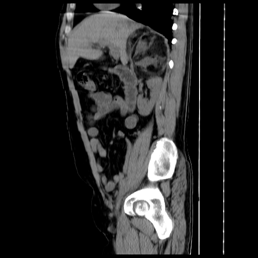 File:Adrenal myelolipoma (Radiopaedia 41843-44834 Sagittal non-contrast 14).jpg