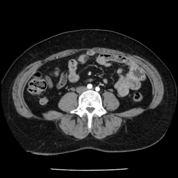 Adrenal myelolipoma (Radiopaedia 43401-46759 Axial C+ arterial phase 63).jpg