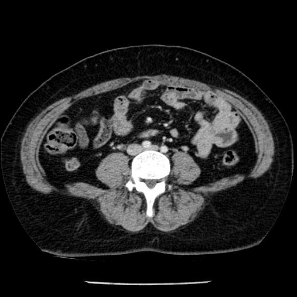 Adrenal myelolipoma (Radiopaedia 43401-46759 Axial C+ portal venous phase 53).jpg