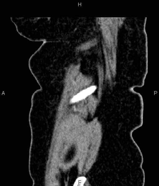 Adrenal myelolipoma (Radiopaedia 82742-96986 Sagittal renal cortical phase 101).jpg