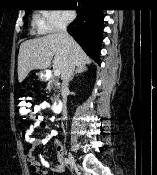 Adrenal myelolipoma (Radiopaedia 84319-99617 Sagittal renal cortical phase 38).jpg