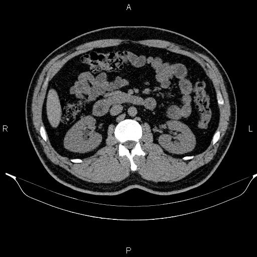 Adrenal myelolipoma (Radiopaedia 84321-99619 Axial non-contrast 49).jpg
