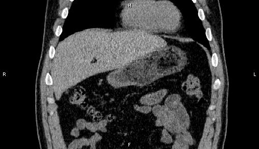 Adrenal myelolipoma (Radiopaedia 84321-99619 Coronal non-contrast 17).jpg