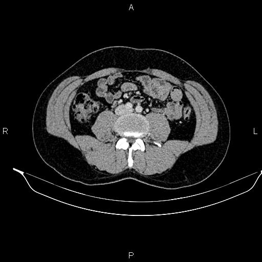 Adrenal myelolipoma (Radiopaedia 87794-104246 Axial renal cortical phase 62).jpg