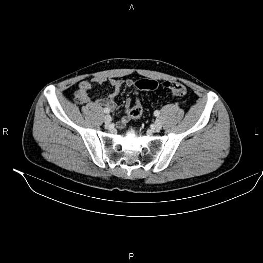 Adrenal myelolipoma (Radiopaedia 87794-104246 Axial renal cortical phase 84).jpg
