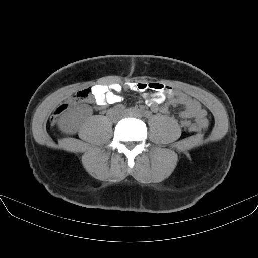Adrenal myelolipoma - bilateral (Radiopaedia 74805-85810 Axial non-contrast 49).jpg