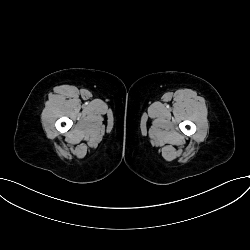 Adrenocortical carcinoma (Radiopaedia 87281-103569 Axial C+ portal venous phase 104).jpg