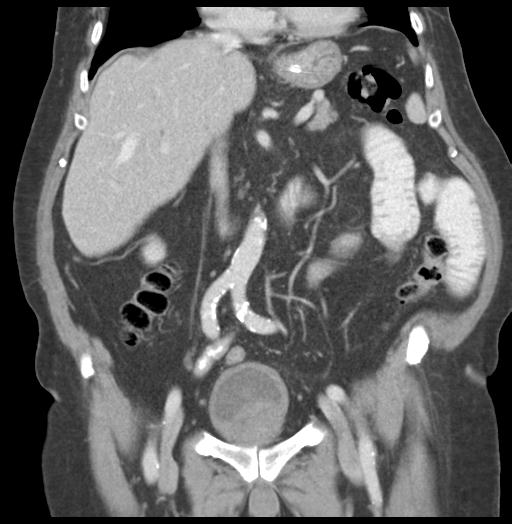 Adult ileal intussusception with secondary obstruction (Radiopaedia 30395-31051 Coronal C+ portal venous phase 30).jpg