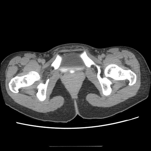 Adult polycystic kidney disease (Radiopaedia 48845-53876 Axial renal excretory phase 97).jpg