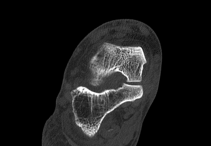 Advanced osteomyelitis due to open metatarsal fracture (Radiopaedia 83891-99095 Axial bone window 10).jpg