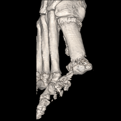 File:Advanced osteomyelitis due to open metatarsal fracture (Radiopaedia 83891-99095 VRT 10).jpg