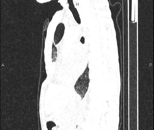 File:Air bronchogram in pneumonia (Radiopaedia 85719-101512 Sagittal lung window 49).jpg