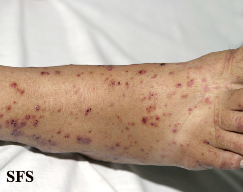 Allergic Vasculitis (Dermatology Atlas 14).jpg