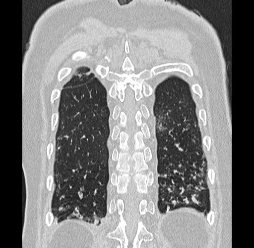 Alpha-1-antitrypsin deficiency (Radiopaedia 72058-82557 Coronal lung window 88).jpg