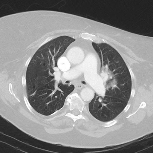 Alveolar hemorrhage and possible lymphocytic interstitial pneumonitis in systemic lupus erythematosus (Radiopaedia 28582-28839 Axial lung window 21).jpg