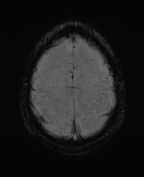 File:Alzheimer's disease- with Gerstmann syndrome and dressing apraxia (Radiopaedia 54882-61150 Axial SWI 29).png