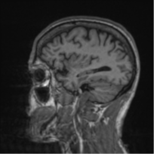 Alzheimer's disease- with apraxia (Radiopaedia 54763-61011 Sagittal T1 19).png