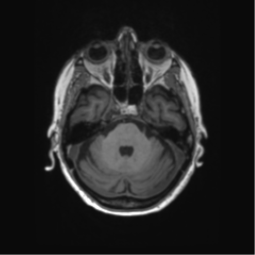 File:Alzheimer's disease (Radiopaedia 42658-45802 Axial T1 112).png