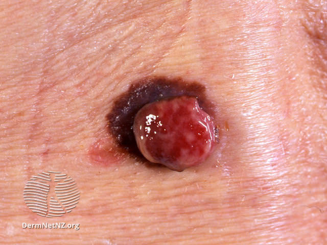File:Amelanotic melanoma arising wihtin pigmented melanoma (DermNet NZ amelanotic-melanoma-018).jpg