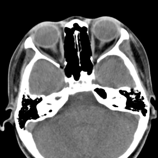 File:Ameloblastoma (Radiopaedia 26645-26793 Axial C+ delayed 40).jpg