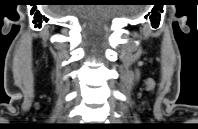 File:Ameloblastoma (Radiopaedia 33677-34806 Coronal non-contrast 50).png