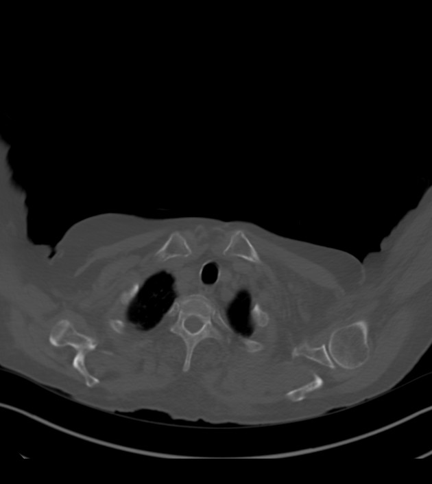 Amiodarone deposition in the liver (Radiopaedia 77587-89780 Axial bone window 9).jpg