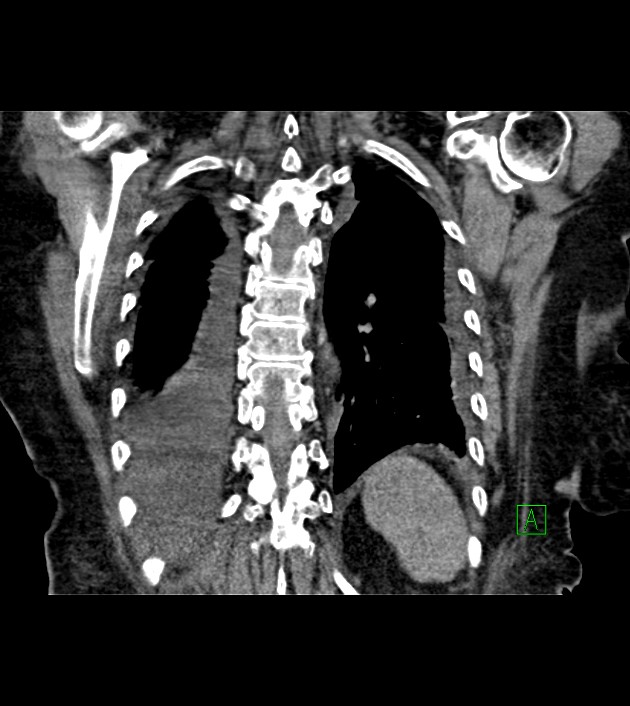 Amiodarone deposition in the liver (Radiopaedia 77587-89780 Coronal non-contrast 59).jpg