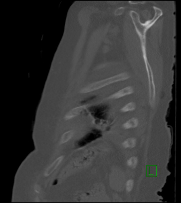 Amiodarone deposition in the liver (Radiopaedia 77587-89780 Sagittal bone window 18).jpg