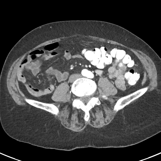 Ampullary adenocarcinoma (Radiopaedia 34013-35237 B 62).png