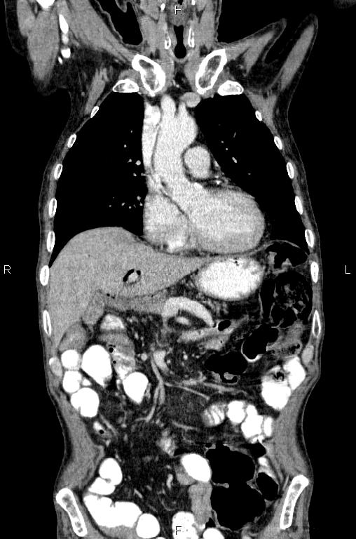 Ampullary adenocarcinoma (Radiopaedia 86093-102033 D 21).jpg
