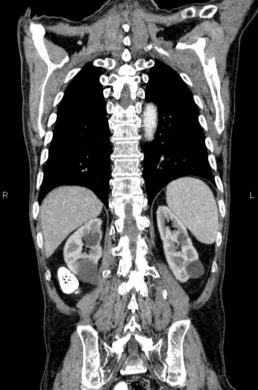 Ampullary adenocarcinoma (Radiopaedia 86093-102033 D 48).jpg