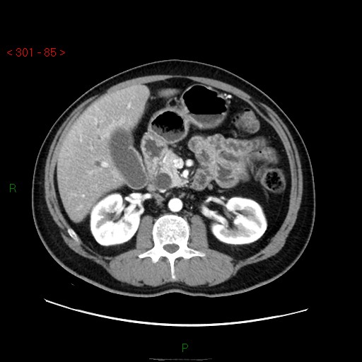 Ampullary carcinoma (Radiopaedia 56396-63056 B 31).jpg