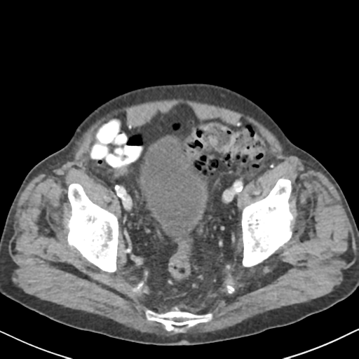 File:Amyand hernia (Radiopaedia 39300-41547 A 62).png