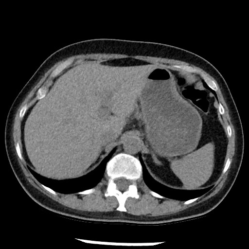 Amyloidosis - bronchial and diffuse nodular pulmonary involvement (Radiopaedia 60156-67744 Axial non-contrast 54).jpg