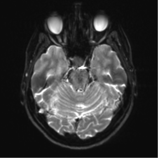 Anaplastic astrocytoma - thalamic glioma (Radiopaedia 59709-67115 Axial DWI 11).png