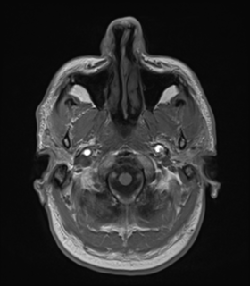 Anaplastic astrocytoma IDH wild-type (Radiopaedia 49984-55273 Axial T1 7).png