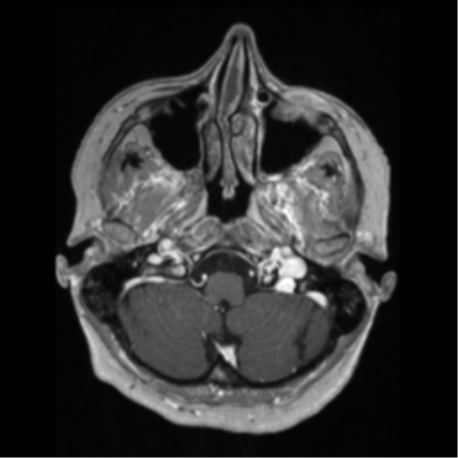 File:Anaplastic astrocytoma IDH wild-type (pseudoprogression) (Radiopaedia 42209-45276 Axial T1 C+ 29).png