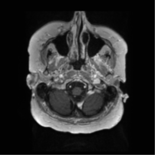 Anaplastic astrocytoma IDH wild-type (pseudoprogression) (Radiopaedia 42209-45279 Axial T1 C+ 18).png